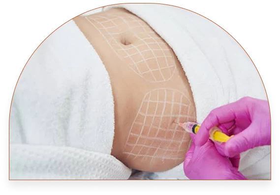 Fat Dissolving Injections results at SK'N THEORY