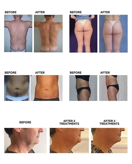 Fat Dissolving Injections consultation at SK'N THEORY