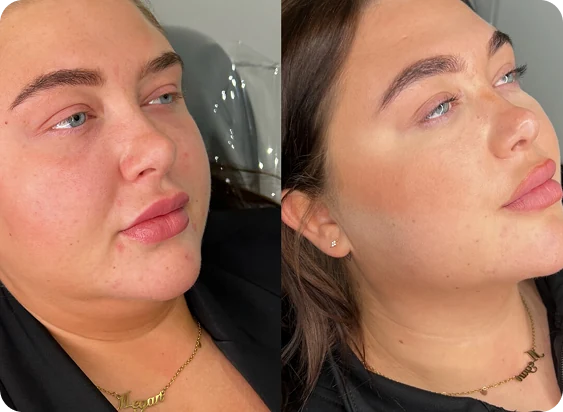 Fat Dissolving Injections at SK'N THEORY clinic in Karachi
