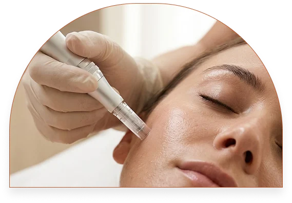 Microneedling results at SK'N THEORY