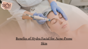 Benefits of HydraFacial for Acne-Prone Skin