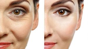 Botox Treatment: What Every First-Timer Should Know